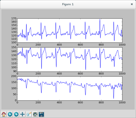 Drei EKG-Kanäle mit erkennbarem Puls